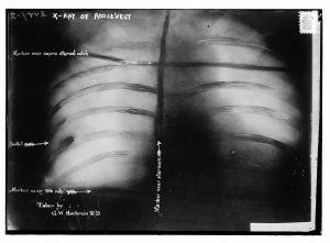 Teddy Roosevelt's Bullet-Riddled Rib Cage (1912)