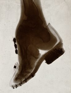 X-ray showing foot binding impact on a Chinese woman, 1920s.