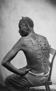 Scars of Gordon, back of a whipped Mississippi slave, circa 1863.